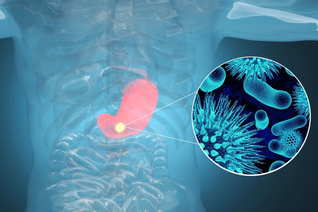 肿瘤标记物CA72-4：“胃”，你还好吗？